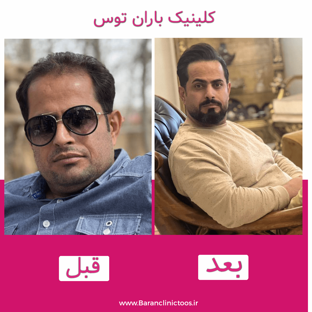 قبل و بعد کاشت مو